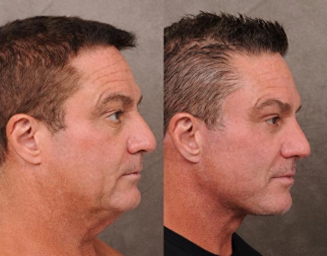 硅谷男人熱衷整容?30歲裁員危機:科技圈整形熱潮背后的焦慮