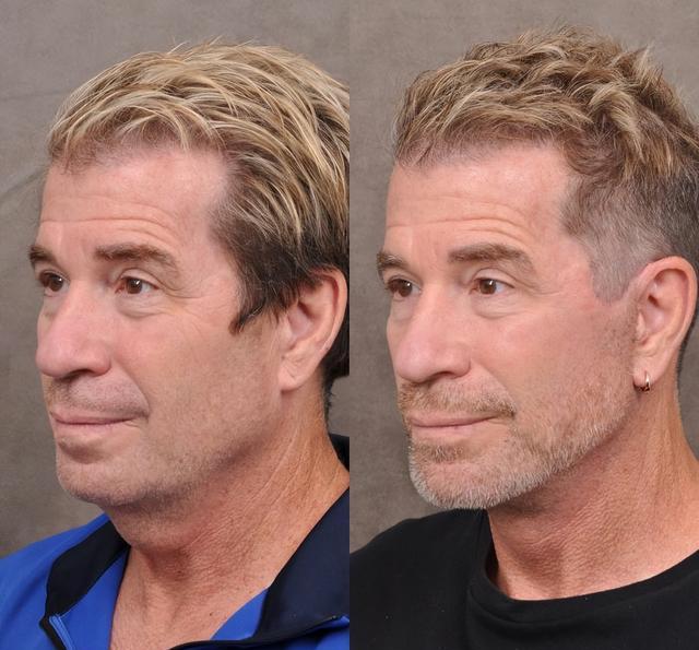 硅谷男人熱衷整容?30歲裁員危機:科技圈整形熱潮背后的焦慮