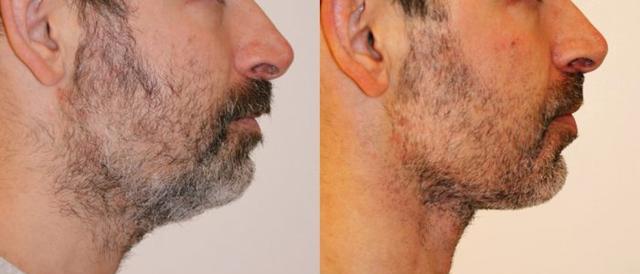 硅谷男人熱衷整容?30歲裁員危機:科技圈整形熱潮背后的焦慮